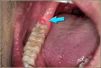 Removal of the root of the tooth is a complicated, but the most painless procedure