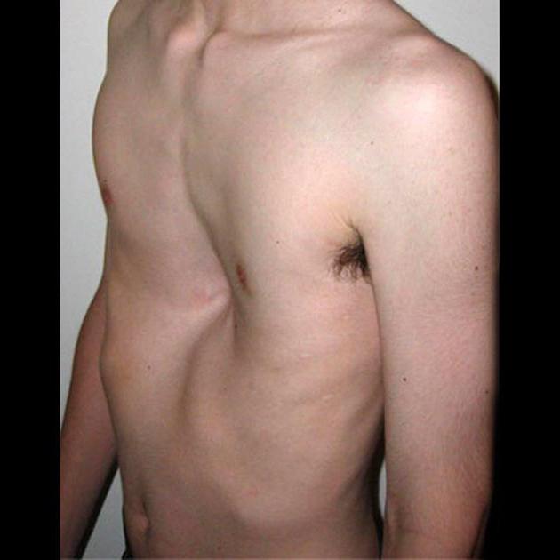Funnel-shaped deformation of the chest: features of occurrence and consequences