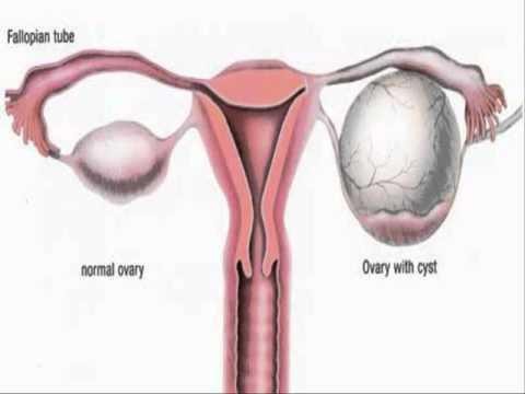 how to treat the follicular ovarian cyst